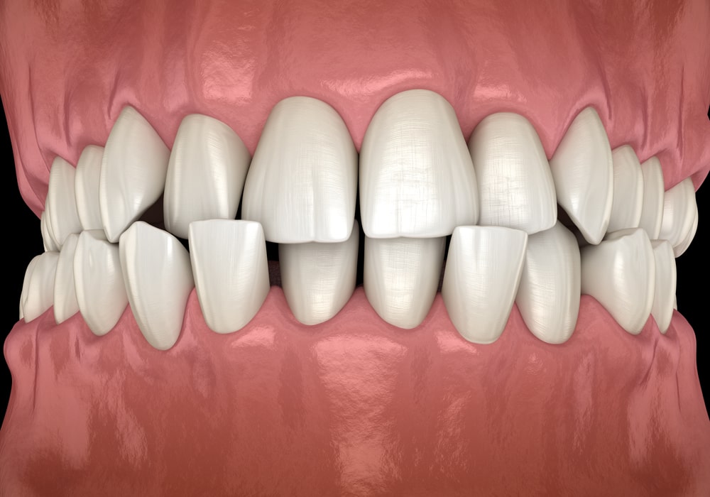 Un crossbite doit être traité en orthodontie